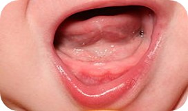 Photograph of a child's mouth ahead of teething